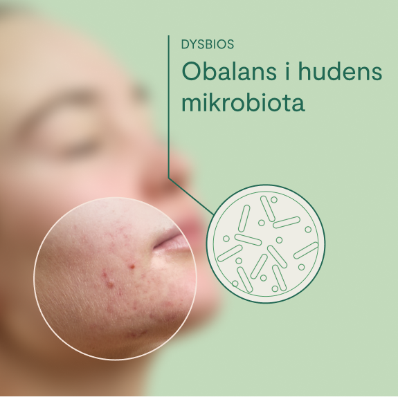 obalans i hudens mikrobiota, vincobiosis, akne