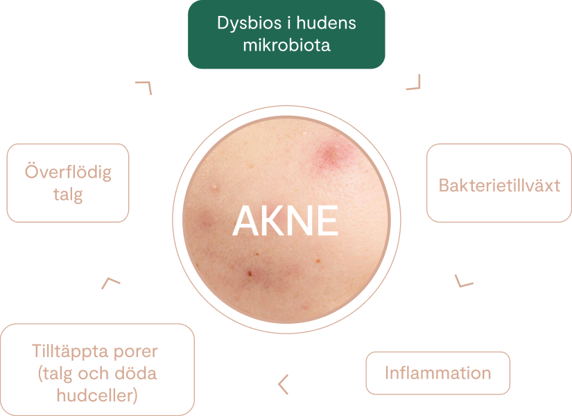 akne, dysbios, finnar, vincobiosis, bakterier på huden